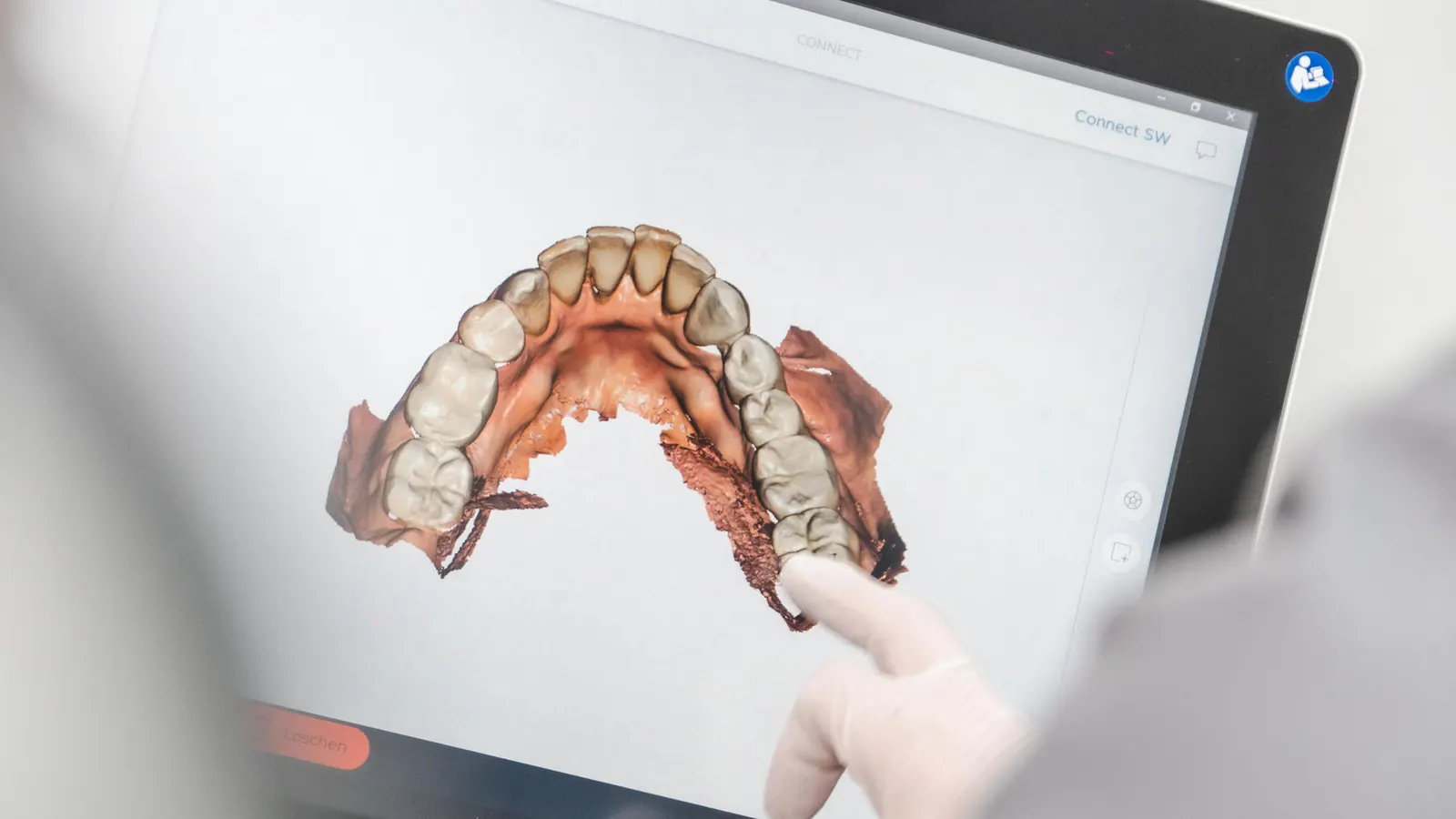 3D-Modell eines Zahnbogens auf dem Bildschirm des Intraoralscanners
