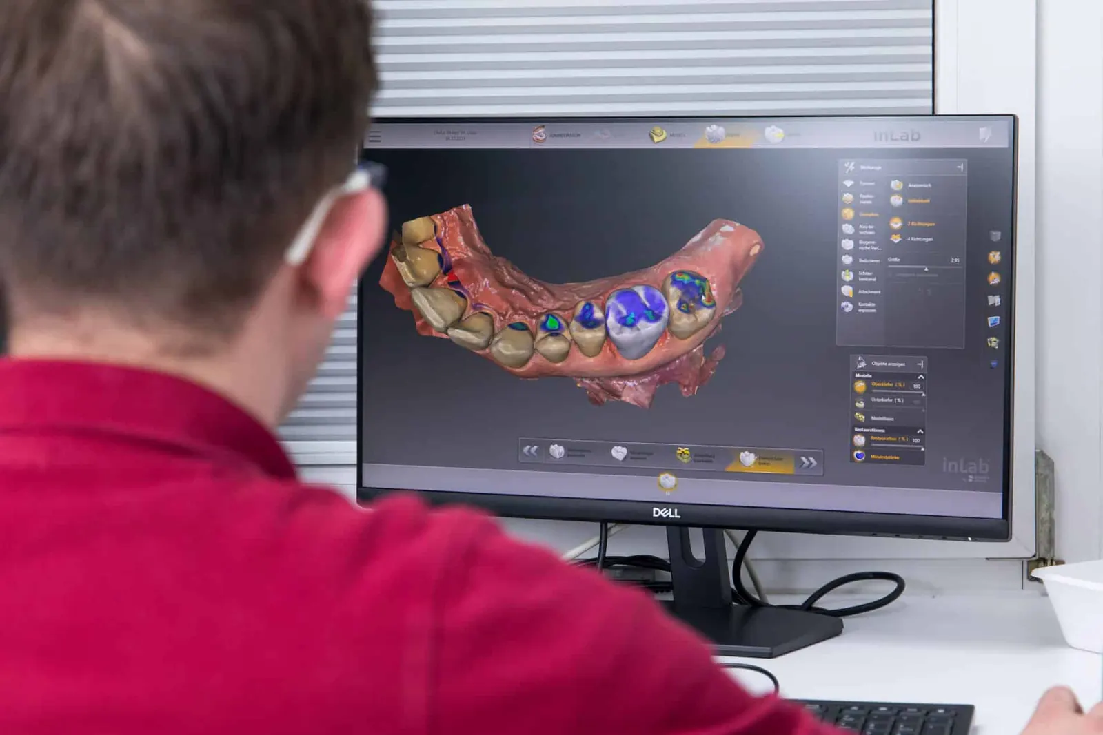 Digitale Planung von Kronen am Computer im Praxislabor